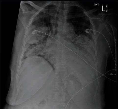 This diagnostic image is an anteroposterior (AP) chest X-ray demonstrating severe, diffuse, and bilateral patchy opacities throughout the lung fields. The findings are highly suggestive of multifocal pneumonia or Acute Respiratory Distress Syndrome (ARDS). Specifically, there are extensive irregular consolidations visible in both the upper and lower lung zones, indicating significant alveolar filling by inflammatory exudate or fluid. The heart borders are partially obscured by the adjacent pulmonary infiltrates. Additionally, multiple medical support devices are visible, including external EKG monitor leads and cables traversing the thoracic region, which indicate the patient is receiving intensive care monitoring. This radiological presentation is characteristic of severe pulmonary infections, such as COVID-19 pneumonia or secondary bacterial coinfection, correlating with acute hypoxemic respiratory failure.