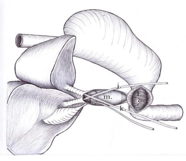 Anatomical diagram illustrating a biliary reconstruction procedure using a pedicled gastric tube. The illustration shows a longitudinal cross-section of the extrahepatic biliary system and the proximal gastrointestinal tract. Key structures are labeled: (i) represents a tube inserted into the gallbladder lumen; (j) and (k) denote stents or tubes placed within the right and left hepatic ducts, respectively. These tubes converge into (m), which is the interior of a pedicled gastric tube used as a conduit for biliary drainage. Structure (l) shows the interior of the duodenum with its characteristic mucosal folds (plicae circulares) and an anastomotic site where the gastric tube connects to the small intestine. The diagram emphasizes the surgical technique of using a gastric wall segment to bridge a common bile duct defect, facilitating passage from the hepatic ducts to the duodenum. This visual material is relevant for surgical oncology and hepatobiliary surgery education, demonstrating complex biliary tract reconstruction.
