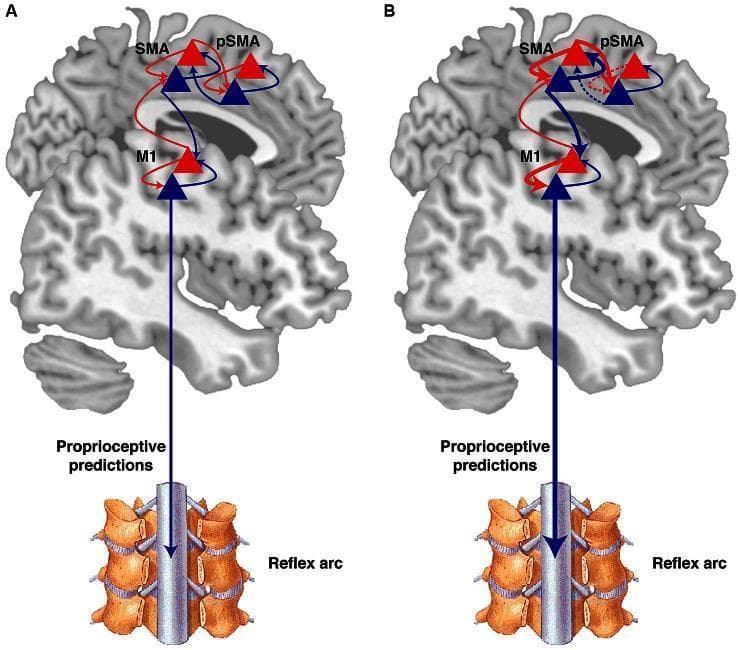A pathophysiology diagram illustrating the active inference theory of voluntary movement and its disruption in psychogenic movement disorders (PMD). The graphic consists of two panels (A and B) featuring a sagittal view of the human brain and a segment of the spinal cord. In both panels, three cortical areas are highlighted: the pre-supplementary motor area (pSMA), supplementary motor area (SMA), and primary motor cortex (M1). Blue triangles represent 'prediction units' (beliefs), and red triangles represent 'prediction error units.' Blue arrows indicate backward projections (predictions), while red arrows indicate forward projections (error signaling). Diagram A depicts a normal hierarchy where predictions flow downward from the pSMA to the spinal cord via SMA and M1, inducing movement through reflex arcs. Diagram B illustrates the pathophysiology of PMD, showing abnormally high precision at intermediate levels. This is visualized by thickened arrows between SMA and M1, and a thickened descending arrow to the spinal cord. Conversely, the high-level connection from pSMA to SMA is represented by a dashed line, symbolizing a loss of agency where intermediate-level prediction errors overwhelm high-level intentional goals.