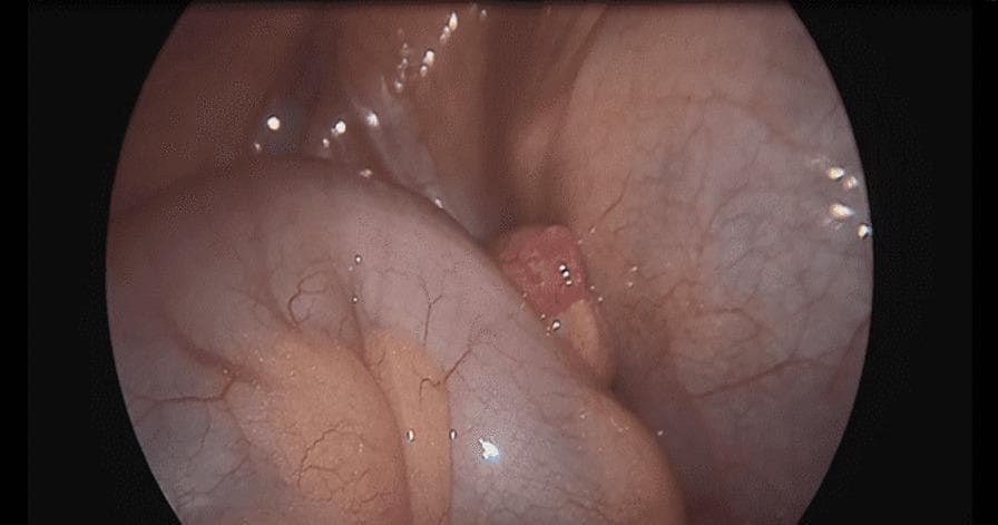 This clinical photograph shows a laparoscopic view of the intra-abdominal cavity, specifically capturing a case of left-sided appendicitis. The distal tip of the appendix is clearly visible, exhibiting distinct signs of inflammation, including erythematous (reddish) discoloration, edema, and a swollen, irregular texture. This inflamed tip is positioned anatomically within the left iliac fossa, a rare variation associated with intestinal malrotation or situs inversus. It is situated between the serosal surfaces of the cecum and the sigmoid colon. The surrounding bowel structures appear relatively healthy with smooth, pinkish-tan surfaces and visible fine vascular markings (vasa recta). The image serves as an educational example of acute appendicitis and the surgical anatomy involved in identifying an ectopic or malpositioned appendix during laparoscopic exploration. Educational focus is on surgical pathology, anatomical variations, and laparoscopic diagnostic findings in generalized peritonitis.