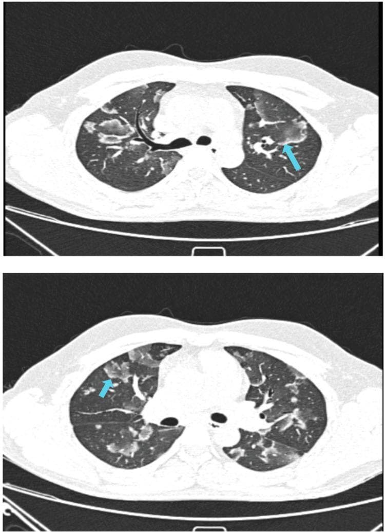 This diagnostic image consists of two axial non-contrast CT sections of the thorax in lung window setting, demonstrating bilateral pulmonary abnormalities characteristic of Cryptogenic Organizing Pneumonia (COP). The primary findings are multifocal ground-glass opacities (GGO) and areas of consolidation. Notably, both sections display the 'reverse halo sign' (or 'atoll sign'), indicated by blue arrows, where a central area of ground-glass attenuation is surrounded by a crescentic or ring-like rim of denser consolidation. These lesions are distributed throughout the lung parenchyma with a predominantly subpleural and peribronchovascular orientation. The image illustrates a classic radiological manifestation of interstitial lung disease (ILD), specifically organizing pneumonia, highlighting the distinction between partial alveolar filling (GGO) and complete airspace replacement (consolidation). This material is suitable for advanced medical education in radiology and pulmonology focusing on the differential diagnosis of diffuse parenchymal lung diseases.