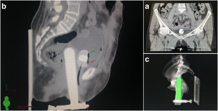 This composite diagnostic image demonstrates radiotherapy planning for cervical or vaginal cancer using a vaginal applicator and Foley catheter. Image (b) shows a fused sagittal planning CT scan illustrating the longitudinal displacement of the Foley catheter balloon under two different tension levels: standard tension (Position A, green arrow) and extra tension (Position B, red arrow), which shifts the balloon caudally. Image (a) provides a coronal view where a blue arrow identifies the bladder reference point at the center of the catheter balloon, used for ICRU 38 dose reporting. Image (c) presents a Digitally Reconstructed Radiograph (DRR) derived from the CT scan at standard tension, visualizing the high-density vaginal applicator (highlighted in green) in relation to the pelvic skeletal anatomy. This clinical imaging series is used to evaluate the robustness of dose parameters and the spatial stability of organs at risk, specifically the bladder, during brachytherapy applicator placement.