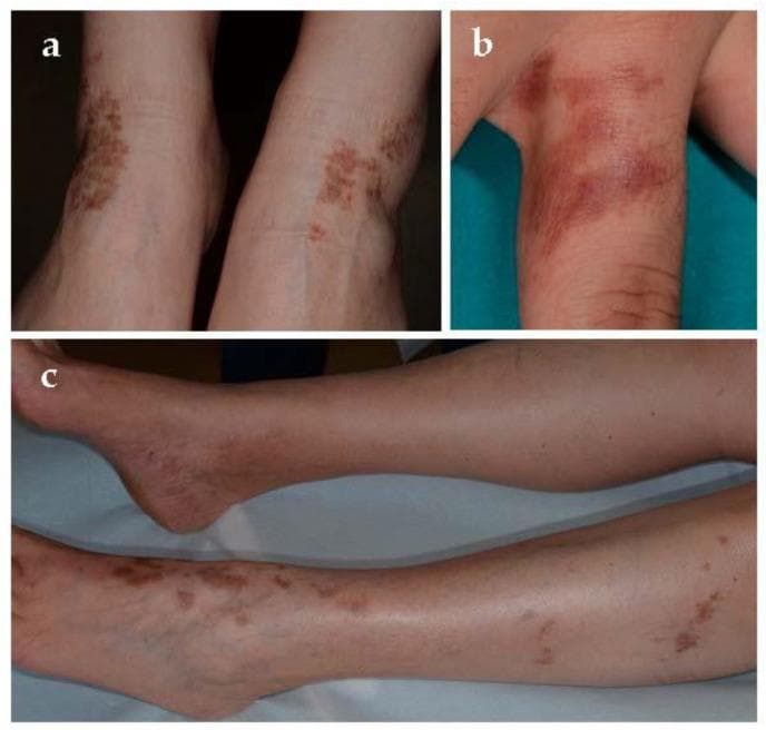 This clinical photograph displays characteristic skin lesions of Lichen aureus, a localized variant of pigmented purpuric dermatosis. Panel (a) illustrates bilateral, symmetrical yellow-brown to golden patches situated over the medial and lateral malleoli of the lower legs. These patches are formed by the coalescence of individual purpuric papules, creating a 'cayenne pepper' appearance. Panel (b) shows a focal, rust-colored to purple-brown patch on the first phalanx of the third finger, demonstrating a linear and well-circumscribed morphology following the digit's contour. Panel (c) provides a wider view of the lower extremities, highlighting the chronic distribution of these copper-toned macules and patches along the ankles and distal shins. The images demonstrate the hallmark 'golden' (aureus) discoloration caused by hemosiderin deposition within the dermis. This material is primarily intended for dermatology education regarding the clinical recognition of localized purpuric eruptions and their distinct morphological features compared to other chronic pigmented purpuras.