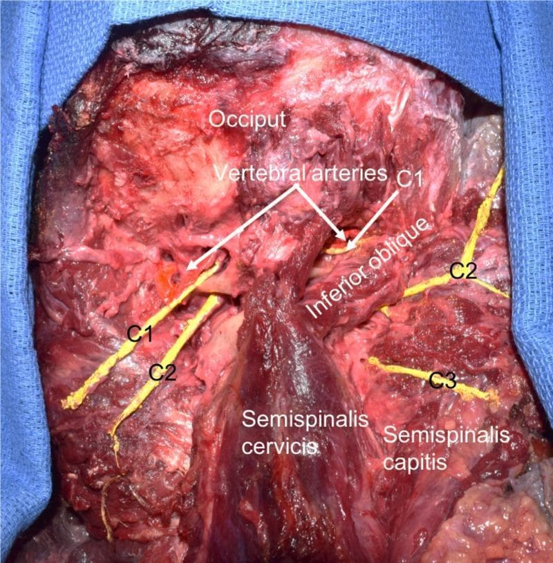 This clinical photograph displays a posterior anatomical dissection of the suboccipital region in a human cadaver, highlighting key neurovascular and muscular structures. Labels identify the occiput, vertebral arteries, inferior oblique muscle, semispinalis cervicis, and semispinalis capitis (reflected laterally). Crucially, the image demonstrates a comparative view of the suboccipital nerves (dorsal rami of C1). On the specimen's left side, a significantly enlarged and elongated dorsal ramus of C1 is visible, coursing medially to the vertebral artery as it crosses the posterior arch of the atlas. In contrast, the right-sided C1 nerve exhibits typical morphology. The dorsal rami of the C2 and C3 spinal nerves are also identified bilaterally, positioned inferior to the suboccipital triangle. The dissection illustrates the spatial relationship between the vertebral artery and the suboccipital muscles, specifically showing the artery's proximity to the inferior oblique muscle. This specimen serves as an educational example of anatomical variation in cervical spinal nerve morphology and suboccipital neuroanatomy.