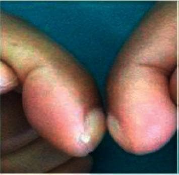 This clinical photograph displays a close-up view of two fingers positioned dorsal surface to dorsal surface to assess for digital clubbing. The image demonstrates a classic presentation of clubbing, characterized by the bulbous, drumstick-like enlargement of the distal phalanges. There is a visible increase in the longitudinal and transverse curvature of the nails, along with the softening of the nail bed. Crucially, the image illustrates a positive Schamroth's sign, identified by the complete absence of the normal diamond-shaped window (Schamroth's window) between the opposed nail beds. This physical finding is a hallmark of hypertrophic osteoarthropathy (HOA) and can be associated with chronic underlying conditions such as pulmonary malignancy, cystic fibrosis, or cyanotic heart disease. The photograph serves as an educational reference for medical trainees to recognize morphological fingertip changes and the clinical examination technique for thoracic and systemic disease markers.