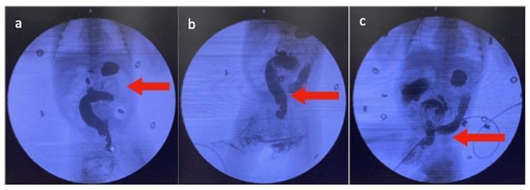 A series of three fluoroscopic images (a, b, and c) from a pediatric contrast enema study, likely in a neonate, evaluating for Hirschsprung's disease. The images demonstrate the retrograde flow of radiopaque contrast material through the distal colon. Image (a) shows the contrast filling the sigmoid and descending colon, with a notable distension of the abdomen visible. Image (b) highlights irregular wall contractions in the contrast-filled segment (red arrow). Image (c) clearly depicts a classic 'transition zone' (red arrow), where there is a sudden and marked change in bowel diameter between a distal, narrowed aganglionic segment and a more proximal, dilated segment of the colon. This radiographic finding is highly suggestive of intestinal obstruction secondary to Hirschsprung's disease. The imaging sequence captures the dynamic nature of bowel motility and the distinct transition point necessary for pediatric surgical diagnosis.