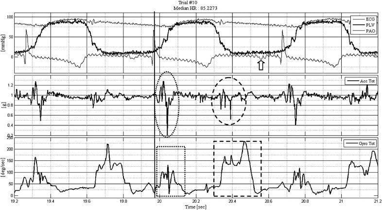 A three-panel physiological waveform diagram illustrating the temporal relationship between cardiac hemodynamics and motion sensor signals. The upper panel displays a synchronized Electrocardiogram (ECG), Left Ventricular Pressure (PLV), and Aortic Pressure (PAO). A vertical arrow highlights the P wave, while a vertical line marks the R wave, corresponding to the onset of ventricular systole where PLV rises and eventually equilibrates with PAO. The middle panel shows the total composite accelerometer (Acc Tot) signal, with a dotted ellipse identifying the systolic tension onset signal (STOS) and a dashed ellipse highlighting the diastolic acceleration component. The lower panel displays the total angular velocity (Gyro Tot) signal measured in degrees per second, with a dotted box marking the systolic gyroscopic activity and a dashed box outlining the diastolic phase. These waveforms demonstrate that mechanical motion signals from accelerometers and gyroscopes correlate with specific phases of the cardiac cycle, such as systolic contraction and diastolic filling, as defined by the concurrent pressure and ECG traces.