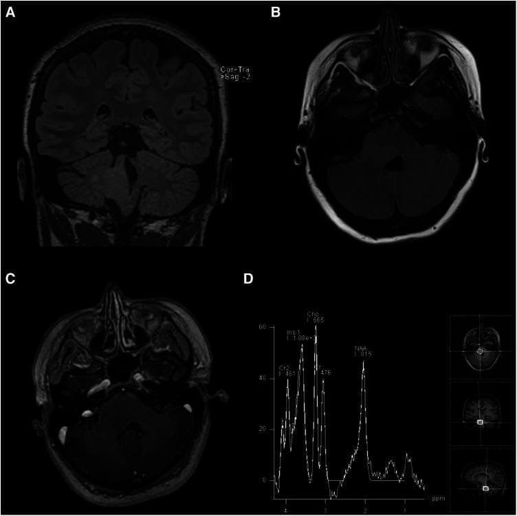This composite of four images (A-D) presents a multi-modal MRI evaluation of a brainstem lesion. Panels (A) Coronal T2-weighted FLAIR and (B) Axial T2-weighted FLAIR demonstrate an ill-defined, hyperintense, and expansile mass within the right pons. The lesion extends into the right middle cerebellar peduncle and the right posterolateral medulla, causing partial effacement of the fourth ventricle. Panel (C) represents an axial post-gadolinium contrast T1-weighted image, which shows no contrast enhancement, indicating a preserved blood-brain barrier within the lesion. Panel (D) provides Magnetic Resonance Spectroscopy (MRS) data, showing a markedly increased choline (Cho) peak and a significantly decreased N-acetylaspartate (NAA) peak. This metabolic profile (high Cho:NAA ratio) is characteristic of increased cellular turnover and loss of neuronal integrity, typically seen in infiltrating gliomas such as Diffuse Intrinsic Pontine Glioma (DIPG). The findings are essential for neurosurgical and oncological education regarding the diagnostic imaging and metabolic characteristics of pediatric-type diffuse low-grade gliomas in adult patients.