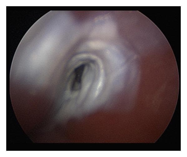 This clinical diagnostic image shows a direct laryngoscopic view of the right pyriform sinus apex in a patient with a suspected branchial cleft cyst. Centrally, the image demonstrates a small, dark, oval fistulous tract opening. The immediate perifistular tissue exhibits a blanched, white-to-light-gray appearance, characteristic of chemical cauterization following the application of 40% trichloroacetic acid (TCA). The surrounding pharyngeal mucosa is reddish-pink with a moist, glistening texture. This visual represents the intraoperative endpoint of chemocauterization for the management of a branchial cleft fistula, where the goal is to induce mucosal inflammation and subsequent fibrosis to achieve tract closure. The anatomical context is critical for otolaryngologists in identifying and treating congenital neck anomalies through endoscopic approaches.