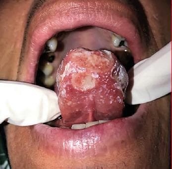 This clinical photograph shows an intraoral view of a patient's tongue with a prominent lesion. The primary pathology is a large, poorly defined ulcerative lesion located at the apex (tip) of the tongue. The lesion displays a variegated appearance, characterized by an erythematous (red) base with irregular areas of white slough and fibrinous pseudomembrane coating. The borders of the ulcer are indistinct and merged with the surrounding inflamed mucosa. The dorsal surface of the tongue shows diffuse erythema and textural changes consistent with chronic inflammation. Background oral structures show secondary clinical findings, including visible dental caries and mild gingival recession. The visual presentation is highly characteristic of granulomatous oral conditions, such as primary or secondary oral tuberculosis, which typically present as non-healing, painful chronic ulcers. The image serves as an educational example of deep fungal or mycobacterial oral manifestations, highlighting the need for biopsy and differential diagnosis from squamous cell carcinoma.