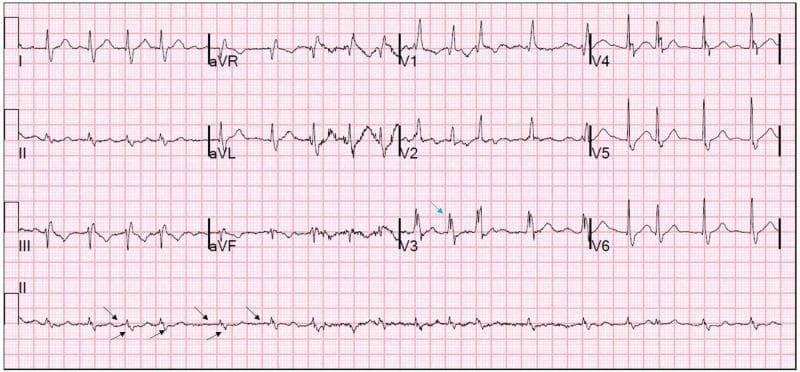 A standard 12-lead electrocardiogram (ECG) displayed on a pink grid background. The tracing demonstrates atrial fibrillation (AF) and a right bundle branch block (RBBB). Diagnostic features of AF include an irregularly irregular ventricular rhythm, absence of discernible P waves, and an irregular, fibrillatory baseline (indicated by black arrows on the rhythm strip). The QRS complexes show widened morphology with a duration exceeding 120 ms. In lead V1, a classic RSR' pattern ('bunny ears') is visible, characteristic of a right bundle branch block. Lead I and V6 show slurred S waves, further supporting the RBBB diagnosis. The ventricular rate is approximately 108 beats per minute, representing AF with a rapid ventricular response. The image provides clinical evidence of supraventricular arrhythmia combined with intraventricular conduction delay, common in patients with underlying cardiovascular disease or acute systemic triggers.