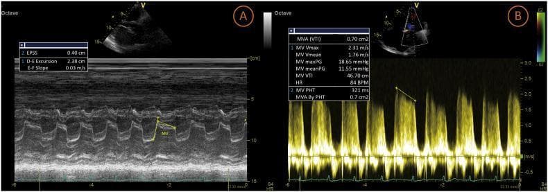 This diagnostic image consists of two panels (A and B) demonstrating echocardiographic findings of severe mitral stenosis. Panel A is an M-mode echocardiogram of the mitral valve showing characteristic morphology of stenotic leaflets. Key visible findings include a significantly flattened E-F slope (measured at 0.03 m/s), indicating slow early diastolic closure, and a decreased D-E excursion (2.38 cm) with a measured EPSS of 0.40 cm. Panel B displays a continuous-wave Doppler echocardiography tracing across the mitral valve. The Doppler envelope shows increased diastolic flow velocities and a prolonged pressure half-time (PHT). Superimposed hemodynamic data indicates a mean pressure gradient (MV meanPG) of 11.55 mmHg, a maximum velocity (Vmax) of 2.31 m/s, and a calculated mitral valve area (MVA) of 0.70 cm² by both velocity time integral (VTI) and pressure half-time (PHT 321 ms). These quantitative and qualitative features are diagnostic of severe rheumatic mitral stenosis, characterized by restricted leaflet mobility and high-pressure transvalvular gradients.