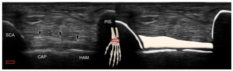 This composite image illustrates the musculoskeletal ultrasound anatomy of the volar wrist, specifically focusing on the scaphotriquetral ligament. The left panel shows a grayscale ultrasound image in the transverse plane. Four carpal bones are identified by their hyperechoic cortical surfaces with posterior acoustic shadowing: the scaphoid (SCA) at the radial aspect, the capitate (CAP) and hamate (HAM) forming the floor, and the pisiform (PIS) at the ulnar aspect. Black arrowheads highlight the scaphotriquetral ligament, which appears as a homogenous, hyperechoic fibrillar band coursing superficially over the capitate and hamate, connecting the scaphoid tubercle toward the triquetrum. The right panel provides a schematic overlay on the same ultrasound image to clearly delineate the ligamentous borders and bony interfaces. An anatomical inset showing a skeletal hand model with a red transducer icon indicates the scanning position distal to the wrist crease. This material is designed for teaching sonographic identification of intrinsic wrist ligaments and their spatial relationships to the carpal rows.
