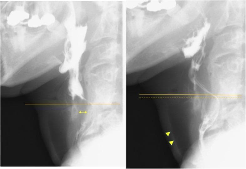 Side-by-side lateral view radiographic images from a postoperative barium swallow study demonstrating normal pharyngeal swallowing mechanics. Image (a) captures the early pharyngeal phase, highlighting the anatomical interval (double-headed arrow) between the cricoid cartilage and the cervical spine following the resection of a synostosis. A solid horizontal line marks the baseline height of the superior cricoid cartilage. Image (b) shows the late pharyngeal-early esophageal phase. Successful airway protection is indicated by the absence of contrast material in the trachea (arrowheads). Improved laryngeal elevation is visually quantified by comparing the new superior position of the cricoid (solid line) against its starting position (dotted line). The images serve as clinical evidence of restored swallowing function, showing proper bolus transit into the esophagus without aspiration after surgical intervention for dysphagia.