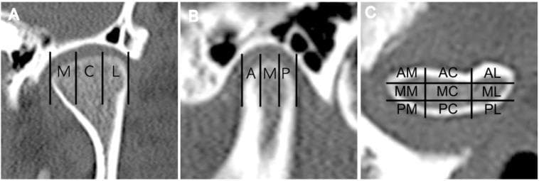 A composite clinical diagnostic image showing three specialized CT scan views (a, b, and c) of the mandibular condyle, illustrating a standardized evaluation approach for temporomandibular joint (TMJ) osteoarthritis. Frame (a) demonstrates a coronal CT view with the condylar head divided into three medio-lateral zones: medial (M), central (C), and lateral (L). Frame (b) shows a sagittal CT view dividing the condyle into three antero-posterior zones: anterior (A), middle (M), and posterior (P). Frame (c) presents an axial or superior view demonstrating a nine-section grid used to calculate the Destructive Change Index (DCI). The grid labels correspond to anatomical orientations: AM (antero-medial), AC (antero-central), AL (antero-lateral), MM (mid-medial), MC (mid-central), ML (mid-lateral), PM (postero-medial), PC (postero-central), and PL (postero-lateral). This methodology facilitates the objective quantification of osseous destruction, such as erosion and subchondral cysts, in patients with TMJ disorders.