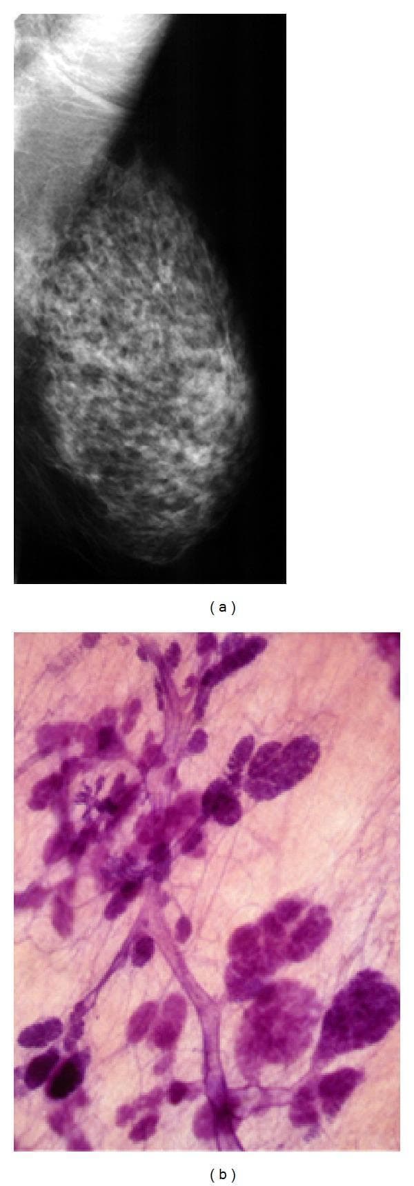 This composite educational material demonstrates a radiological-pathological correlation of normal breast anatomy. Image (a) is a mammogram of the left breast in a mediolateral oblique (MLO) projection. It illustrates nodular and oval-shaped opacities representing terminal duct lobular units (TDLUs), alongside linear densities corresponding to larger milk ducts. These structures are embedded within radiolucent (dark) adipose tissue, providing high natural contrast. Image (b) presents a large-section, subgross (3D) histology specimen stained with hematoxylin and eosin (H&E). The microscopy shows dark purple stained ductal networks and lobular clusters against a lighter pink connective tissue background. The comparison highlights how the 3D histological arrangement of lobules and ducts directly correlates with the radiographic densities seen on a mammogram. This material is designed for medical students and radiology residents to understand the structural basis of mammographic findings and the importance of large-section histology in visualizing contiguous breast anatomy.