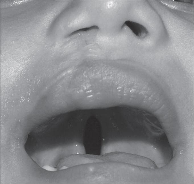 This clinical photograph displays a pediatric patient with a postoperative unilateral (right-side) cleft lip and a concurrent incomplete cleft palate. The external view reveals a vertical surgical scar extending from the right nostril to the vermillion border of the upper lip, indicating a previous cheiloplasty. The right nostril demonstrates mild alar flattening and asymmetry of the nasal sill compared to the contralateral side. The intraoral view shows an open mouth with a clear midline defect in the hard and soft palate, characterizing an incomplete cleft palate. This longitudinal opening provides a direct view into the nasopharynx. The image serves as a clinical demonstration of the anatomical presentation of orofacial clefts and the secondary results of surgical repair. It is relevant for medical training in pediatrics, plastic surgery, and otolaryngology focusing on congenital craniofacial anomalies.