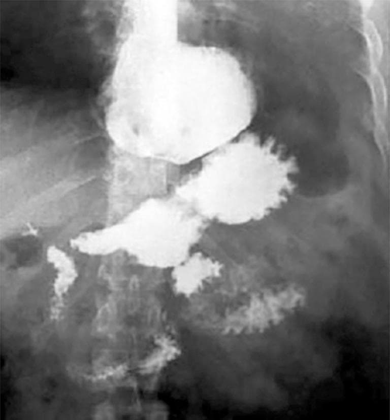 This diagnostic image is an upper gastrointestinal (UGI) seriography, or barium swallow study, utilizing positive contrast to visualize the esophagus, stomach, and duodenum. The primary finding is a large, contrast-filled epiphrenic diverticulum located in the distal esophagus just above the gastroesophageal junction. The diverticulum appears as a prominent, rounded, lateral outpouching of the esophageal lumen. Distal to this, the contrast outlines the gastric fundus, body, and antrum. The proximal duodenum is also visible with characteristic mucosal fold enhancement. The image demonstrates the hallmark radiographic presentation of a large esophageal diverticulum, which can lead to clinical symptoms such as dysphagia and regurgitation. The study is typical of gastroenterology and radiology educational materials focused on esophageal motility disorders and structural abnormalities.