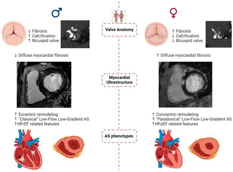 A comparative medical infographic detailing the sex-based differences in the pathophysiology and presentation of aortic stenosis (AS). The diagram is divided into three main rows: Valve Anatomy, Myocardial Ultrastructure, and AS Phenotypes, with males on the left and females on the right. In 'Valve Anatomy', males exhibit a higher prevalence of bicuspid valves with greater calcification and less fibrosis, as shown in anatomical diagrams and axial CT scans. Females show less calcification but higher levels of valvular fibrosis. Under 'Myocardial Ultrastructure', cardiac MRI frames illustrate that males typically present with diffuse myocardial fibrosis and eccentric left ventricular (LV) remodeling. Females demonstrate increased diffuse myocardial fibrosis and concentric LV remodeling. The 'AS Phenotypes' section contrasts 'Classical' Low-Flow Low-Gradient AS in males, often associated with Heart Failure with reduced Ejection Fraction (HFrEF), against 'Paradoxical' Low-Flow Low-Gradient AS in females, associated with Heart Failure with preserved Ejection Fraction (HFpEF). Cross-sectional heart diagrams reinforce these remodeling patterns, showing a dilated LV in the male phenotype and a thickened, small-cavity LV in the female phenotype.