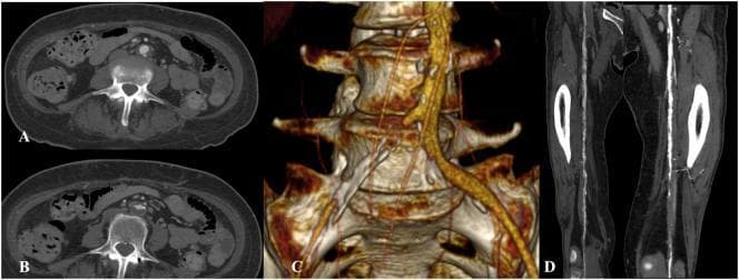 Multi-panel preoperative imaging of the arterial system demonstrating peripheral artery disease (PAD) and extensive atherosclerosis. Panels A and B are axial CT-angiography slices of the infrarenal abdominal aorta showing significant calcified atherosclerotic plaques and mural irregularities. Panel C provides a 3D volume-rendered reconstruction of the abdominal aorta and its bifurcation, highlighting severe vessel tortuosity, an uneven aortic surface, and high-grade stenosis or occlusion at the origin of the right common iliac artery. Panel D displays a coronal maximum intensity projection (MIP) or reformatted view of the bilateral femoral-popliteal axes, illustrating diffuse calcification of the arterial walls and luminal narrowing more pronounced on the right side. The set demonstrates the radiologic manifestations of multilevel atherosclerotic burden in the vascular system, relevant for surgical planning in cases of lower limb ischemia.
