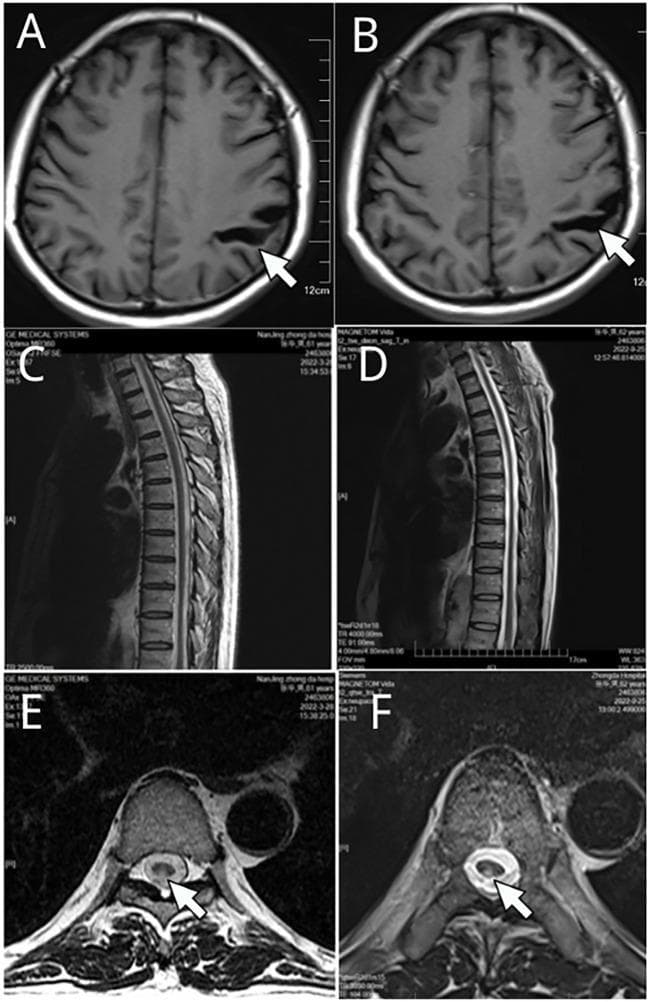 This composite diagnostic image presents a longitudinal Magnetic Resonance Imaging (MRI) comparison of the brain and thoracic spine over a six-month interval (March 2022 and September 2022). Panels A and B are axial T1-weighted cranial scans showing focal cortical atrophy characterized by the widening of the left parietal sulcus (white arrows). Panels C and D provide sagittal T2-weighted views of the thoracic spine, while panels E and F display axial T2-weighted cross-sections. The spinal imaging reveals a hyperintense signal within the posterior columns (dorsal columns) of the spinal cord at the T3-T6 level (white arrows), a finding classically associated with conditions such as neurosyphilis (tabes dorsalis) or subacute combined degeneration. The comparison demonstrates temporal stability of these neurological findings, with no significant progression or resolution between the two time points. This visual material serves as an educational example of identifying specific neuroanatomical pathologies—namely parietal atrophy and dorsal column myelopathy—using multi-planar MRI sequences in the context of chronic infectious or metabolic central nervous system diseases.