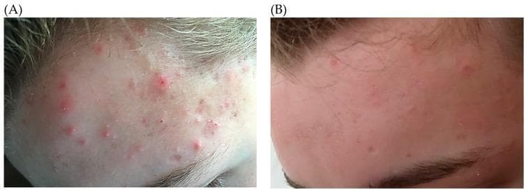 This clinical photograph illustrates a side-by-side comparison (A and B) of a 14-year-old patient with acne vulgaris on the forehead, demonstrating therapeutic progression. Image A shows baseline moderate inflammatory acne, characterized by a high density of erythematous papules, pustules with visible white centers, and underlying non-inflammatory comedones. The skin exhibits significant localized inflammation and an irregular texture. Image B depicts the same anatomical region after three months of treatment with oral minocycline and topical antimicrobial therapy. There is a marked reduction in lesion density and severity, with a transition from active inflammatory papulopustular lesions to sparse residual erythema. The overall skin texture is smoother and the inflammatory response is substantially resolved, showcasing the clinical efficacy of systemic and topical antibiotics in targeting Cutibacterium acnes (formerly Propionibacterium acnes). The content is relevant for dermatological education regarding the classification of acne lesions and the visual assessment of treatment outcomes.