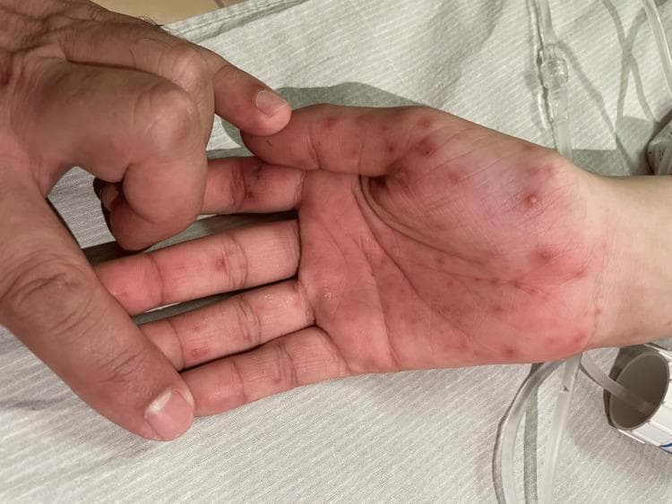 This clinical photograph displays the palm and fingers of a 19-year-old patient, exhibiting classic dermatological manifestations of infective endocarditis. Multiple small, reddish-to-purple macules and papules are distributed across the palmar surface, thenar eminence, and the ventral aspects of the fingers. These include non-tender, erythematous Janeway lesions (representing microabscesses or septic emboli) and potentially painful, raised Osler nodes (representing immune complex deposition). The lesions are approximately 2-5 mm in diameter, mostly circular, and show variable density across the hand. The background context includes medical intravenous (IV) tubing and an examiner's hand, indicating a clinical setting. These peripheral stigmata are critical diagnostic indicators for infective endocarditis, often associated with valvular vegetations and systemic septic embolization. The surrounding skin appears otherwise normal, without confluent erythema, emphasizing the discrete nature of the embolic or immunologic phenomenon.