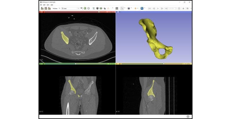 A multi-paneled interface from a medical image computing platform (3D Slicer) demonstrating the anatomical segmentation of the os coxae (hip bone). The display is divided into four quadrants providing a synchronized view of the pelvic anatomy. The top-left panel shows an axial CT slice, the bottom-left shows a coronal CT slice, and the bottom-right shows a sagittal CT slice. In each 2D radiological view, the right os coxae is highlighted with a yellow semi-transparent mask to indicate precise segmentation boundaries against the grayscale bone and soft tissue. The top-right panel features a 3D volumetric reconstruction of the segmented right os coxae in yellow, clearly showing complex morphological landmarks including the iliac crest, the acetabulum, the ischium, and the obturator foramen. This visualization is characteristic of virtual surgical planning (VSP) and anatomical modeling for orthopedic education or preoperative assessment.