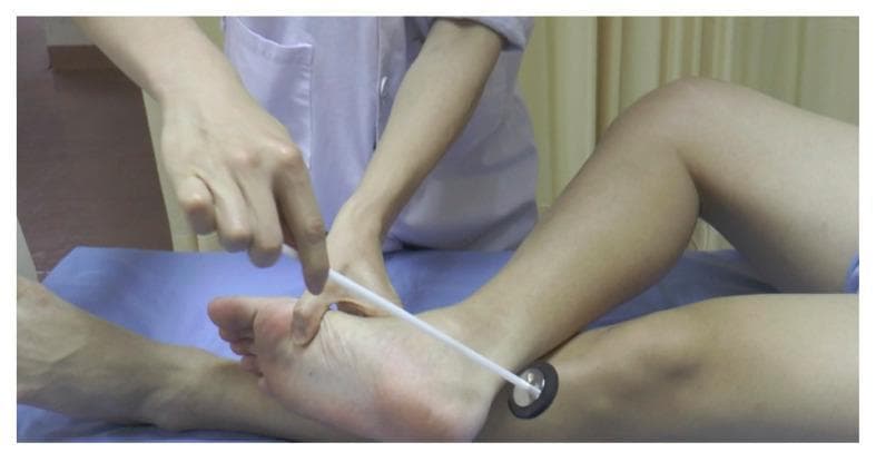 A clinical photograph depicting a neurological examination of the plantar reflex. The patient's leg is positioned in a 'figure four' configuration, characterized by moderate abduction and external rotation of the thigh with the knee flexed, while the examined leg is crossed over the shin of the opposite leg. An examiner uses a Babinski-style reflex hammer—featuring a slender white handle and a circular head with a metallic disk encased in a black rubber ring. The examiner is utilizing the sharpened tip of the handle to stroke the lateral aspect of the sole of the foot to elicit a cutaneous reflex response (Babinski sign). This procedural image demonstrates a common clinical technique for evaluating upper motor neuron integrity within a neurology or physical examination context.