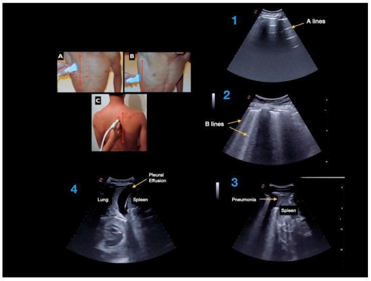 A composite clinical educational image detailing Point-of-Care Ultrasound (PoCUS) techniques and findings for lung examination. The left panels (A, B, C) demonstrate transducer placement for anterior, lateral, and posterior thoracic scans. The right panels display four diagnostic ultrasound frames illustrating key pulmonary artifacts and pathologies. Frame 1 shows 'A-lines', which are horizontal, repetitive echogenic artifacts parallel to the pleural line, indicative of normal aerated lung. Frame 2 demonstrates 'B-lines', vertical laser-like hyperechoic artifacts extending from the pleural line to the bottom of the screen, suggesting interstitial syndrome or pulmonary edema. Frame 3 shows lung consolidation labeled as 'Pneumonia' adjacent to the spleen, characterized by a tissue-like echotexture (hepatization). Frame 4 depicts a 'Pleural Effusion', visible as an anechoic (black) fluid collection superior to the diaphragm, separating the lung from the spleen. This visual resource is intended for medical training in respiratory diagnostics and bedside sonography.