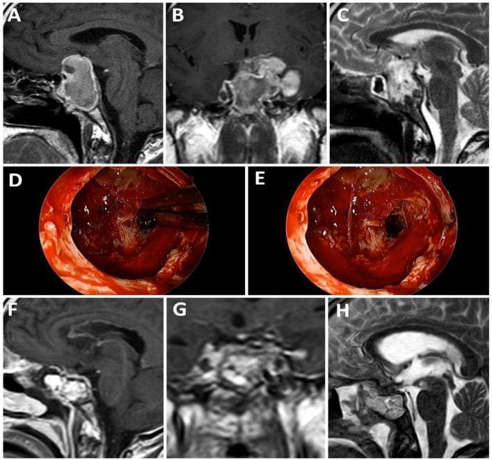 This composite figure illustrates the surgical management of a giant pituitary macroadenoma with apoplexy. Panels A-C display preoperative neuroimaging: (A) T1-weighted sagittal MRI shows a large sellar mass with suprasellar extension and high-signal intensity areas suggesting hemorrhage; (B) T1-weighted post-contrast coronal MRI reveals heterogeneous enhancement and lateral extension toward the cavernous sinuses; (C) T2-weighted sagittal MRI highlights the mass effect on the optic chiasm and third ventricle. Panels D and E are intraoperative endoscopic photographs demonstrating the surgical resection of the hemorrhagic and necrotic tumor tissue via a transsphenoidal approach. Panels F-H show the postoperative MRI results: (F) T1-weighted sagittal, (G) T1-weighted coronal, and (H) T2-weighted sagittal views confirm significant tumor debulking, decompression of the optic chiasm, and restoration of the suprasellar cistern. This case demonstrates the diagnostic findings of pituitary apoplexy and the efficacy of surgical intervention in restoring anatomical relationships in the sellar region.
