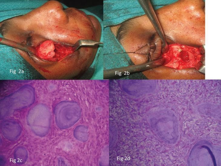 This composite image includes intraoperative clinical photographs and histopathological photomicrographs detailing the surgical management and cellular features of a psammomatoid juvenile ossifying fibroma (PsJOF) in a 15-year-old patient. Panels 2a and 2b show an infraorbital surgical approach. Panel 2a demonstrates the exposure of a pale, well-circumscribed, lobulated mass within the infraorbital rim, while panel 2b shows the site post-excision and peripheral ostectomy, revealing the underlying bony anatomy of the orbit. Panels 2c (10x magnification) and 2d (40x magnification) are H&E-stained photomicrographs showing the pathognomonic features of PsJOF. The histology displays a cellular fibrous stroma containing numerous small, spherical, mineralized ossicles. These ossicles resemble psammoma bodies, characterized by a basophilic appearance and distinct concentric lamellation. The combination of clinical findings and characteristic psammomatoid ossicles is essential for differentiating this aggressive fibro-osseous lesion from conventional ossifying fibromas in pediatric oral and maxillofacial pathology.