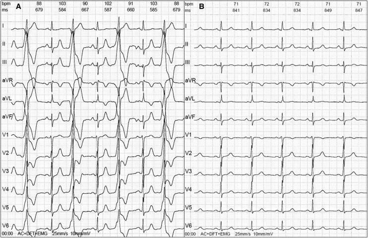 Comparison of two side-by-side 12-lead electrocardiograms (ECGs) representing pre- and post-intervention cardiac rhythms. Panel A displays a 12-lead ECG characterized by ventricular bigeminy, where every normal sinus beat is followed by a premature ventricular complex (PVC). These PVCs are wide, have a different morphology from the narrow sinus complexes, and exhibit discordant T waves. The heart rate fluctuates between 88 and 103 bpm. Panel B displays a subsequent 12-lead ECG showing a return to a stable normal sinus rhythm with a consistent heart rate of approximately 71-72 bpm. In Panel B, there is a regular presence of P waves before each QRS complex, and the QRS complexes are uniform in morphology across all leads (I, II, III, aVR, aVL, aVF, V1-V6). This clinical comparison illustrates the successful resolution of ventricular ectopy following catheter ablation. The educational focus is on identifying PVC patterns and the transition from bigeminy to stable sinus rhythm.