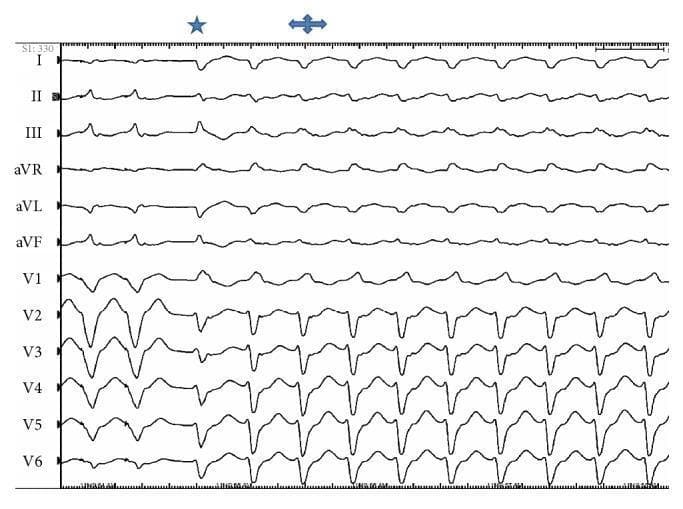 A standard 12-lead electrocardiogram (ECG) tracing showing the induction and maintenance of ventricular tachycardia (VT). The strip displays leads I, II, III, aVR, aVL, aVF, and the precordial leads V1-V6. The initial beats represent sinus rhythm followed by the onset of a wide-complex tachycardia. A star symbol marks the first beat of the VT, which mimics the patient's clinical tachycardia morphology. A double-headed arrow indicates subsequent beats where a subtle, spontaneous change in QRS morphology occurs, though the rhythm remains regular and wide-complex. This visual shift suggests a change in the ventricular exit point, likely related to the papillary muscle origin of the arrhythmia. In the precordial leads (V1-V6), the VT demonstrates a consistent, predominantly negative or biphasic morphology with high amplitude. The tracing is used to illustrate electrophysiological phenomena during VT induction and the variability of activation sites within the ventricular conduction system.