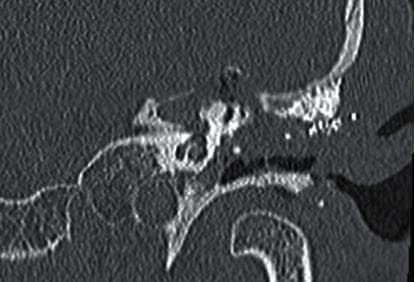 This diagnostic image is a coronal Computed Tomography (CT) scan focusing on the left temporal bone and petrous apex. The scan demonstrates postoperative changes following a surgical intervention for petrous apex pathology, such as a cholesteatoma. Key anatomical findings include an amputated superior semicircular canal, which appears truncated compared to normal morphology. There is a prominent postoperative bone defect in the petrous apex region, characterized by a loss of continuous bony structure and the absence of significant new bone formation within the cavity. Hyperdense material is visible along the superior aspect, corresponding to a titanium mesh previously implanted to stabilize the middle and posterior cranial fossae. The image illustrates the complex surgical anatomy encountered during an extended mastoidectomy and petrous apex approach. This material is highly relevant for neuroradiologists and otolaryngologists studying skull base surgery, surgical complications, and the management of deep temporal bone lesions.