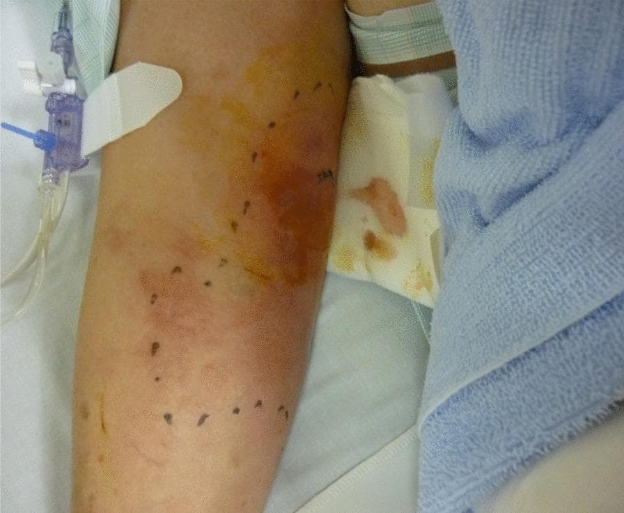 Clinical photograph of a patient's right upper arm demonstrating a significant inflammatory skin lesion. The image shows a large area of confluent erythema (redness) and edema (swelling) extending from the medial aspect of the upper arm down toward the elbow. The affected skin exhibits orange and reddish discoloration. A series of dark surgical marker dots trace the border of the inflamed region, a common clinical practice to monitor the progression or regression of cellulitis or soft tissue infection. Adjacent medical equipment is visible, including an intravenous (IV) catheter with clear tubing secured by a white adhesive dressing on the lateral side of the arm. A partially blood-stained white gauze dressing is located near the axillary region. Clinically, this presentation is consistent with a rapidly progressing soft tissue infection, such as cellulitis or early-stage necrotizing fasciitis, requiring urgent diagnostic evaluation for systemic involvement.