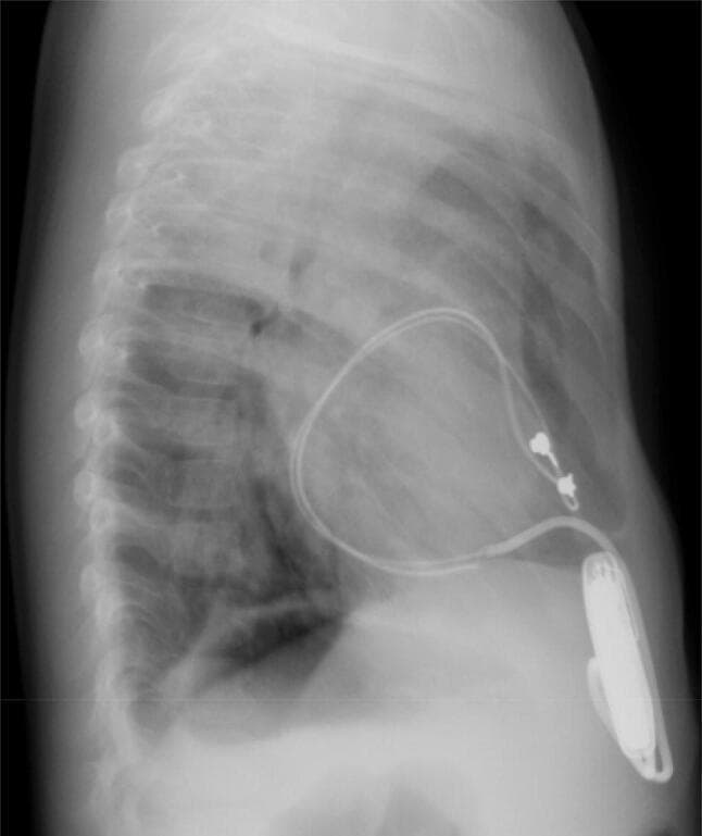 This lateral chest X-ray of a pediatric patient demonstrates the components and configuration of an implanted epicardial pacemaker system. A radiopaque pulse generator is positioned inferiorly within the abdominal wall (rectus sheath). Radiopaque pacing leads extend superiorly from the generator, forming a large, redundant loop that encircles the cardiac silhouette. Notably, the leads follow a posterior course relative to the heart, rather than an anterior or mediastinal path. Two small metallic markers are visible at the leads' distal aspect near the mid-cardiac level. This specific configuration—where the epicardial lead loop completely wraps around the heart—is a diagnostic hallmark of cardiac strangulation, a rare complication where the growing heart is constricted by the non-expanding pacemaker leads. The image highlights the importance of lateral radiographic views in pediatric patients with epicardial pacemakers to assess for lead migration and potential compression of cardiac structures such as the pulmonary artery, atrioventricular groove, and coronary arteries.