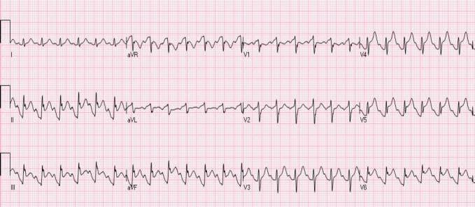 This diagnostic image is a 12-lead electrocardiogram (ECG) demonstrating findings characteristic of Takotsubo syndrome (stress-induced cardiomyopathy). The rhythm shows sinus tachycardia. Key pathological features include significant ST-segment elevation (STE) in the inferior leads (II, III, and aVF) and the anterolateral precordial leads (V4, V5, and V6). Prominent T waves are visible in these same distributions. Reciprocal ST-segment depression is observed in leads aVR and V1. While these visual markers mimic an acute myocardial infarction (STEMI), in the clinical context of Takotsubo syndrome, they represent diffuse ventricular dysfunction rather than acute coronary artery occlusion. The widespread distribution of ST changes—spanning both inferior and anterior territories—is a hallmark used to differentiate this condition from localized ischemia involving a single coronary artery branch. This ECG serves as an important educational example of non-ischemic ST-segment elevation (NISTE).