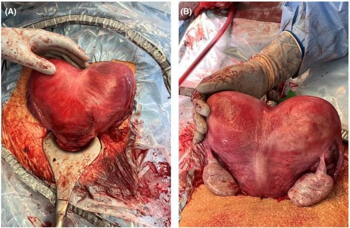 Clinical photograph of a human uterus post-cesarean delivery and hysterotomy repair, demonstrating a bicornuate bicollis anomaly (ASRM classification). The composite image shows (A) an anterior view and (B) a posterior view of the heart-shaped uterus. A deep midline serosal indentation exceeding 1 cm is clearly visible at the fundus, indicative of failed fusion of the Müllerian ducts. The uterine serosa appears erythematous and congested, a physiological finding typical of immediate postpartum and surgical manipulation. In the posterior view (B), both ovaries and fallopian tubes are visible flanking the two distinct uterine horns. The image demonstrates the surgical appearance of a dicavitary uterine anomaly following a twin pregnancy. It serves as an educational reference for Mullerian duct anomalies and their intraoperative presentation during obstetric surgery.