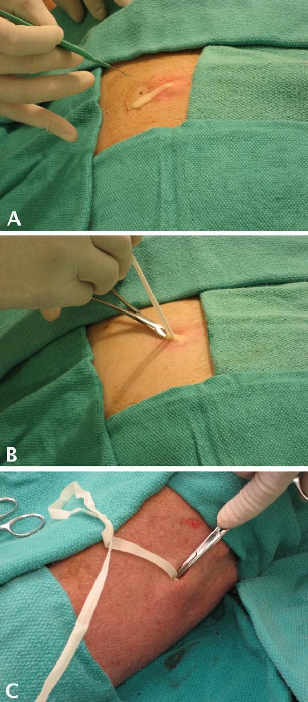 This three-panel clinical instructional photograph demonstrates the sequential steps of an incision and drainage (I&D) procedure using a cadaveric abscess model. Panel A: A gloved hand uses a scalpel to make an incision into a simulated abscess on the abdominal wall, showing the resulting drainage of white, purulent-like material from the raised, erythematous lesion. Panel B: Following the initial drainage, hemostats and a culture swab are used to access the interior of the abscess cavity to simulate the collection of a specimen for microbiology. Panel C: The final stage of the procedure is shown on a lower extremity site, where a gloved operator uses forceps to pack the open abscess cavity with white, ribbon-like iodoform gauze or similar wound-packing material. The area is draped with green surgical cloths throughout the panels. This series serves as an educational tool for medical students and surgical residents to visualize the primary steps of managing cutaneous abscesses, including incision, sampling, and wound packing to prevent premature skin closure.