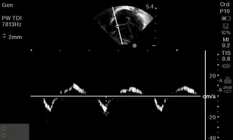 This diagnostic image displays a Pulsed-Wave Tissue Doppler Imaging (PW TDI) echocardiogram used to evaluate right ventricular (RV) diastolic function in a pediatric or neonatal context. The top portion features a 2D grayscale sector view of the heart, with a Doppler cursor and a 2mm sample volume gate positioned at the lateral tricuspid annulus. Below, the spectral Doppler waveform illustrates myocardial velocities over three cardiac cycles. The vertical axis is scaled in cm/s (ranging from +20 to -40), depicting early diastolic (E') and late diastolic (A') velocities. Key technical parameters visible include a Pulse Repetition Frequency (PRF) of 7813 Hz, a Mechanical Index (MI) of 0.2, and a Thermal Index for Soft Tissue (TIS) of 0.8. This modality is essential for quantifying longitudinal myocardial motion and assessing diastolic dysfunction, which is clinically relevant in neonatal conditions such as sepsis, perinatal hypoxia, or meconium aspiration syndrome.