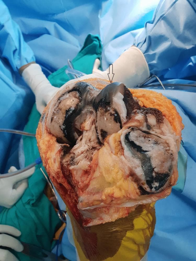 This intraoperative clinical photograph displays a human knee joint during a total knee arthroplasty (TKA). The image shows the distal femur and patellar articular surfaces heavily affected by alkaptonuric ochronosis. There is striking, diffuse dark blue to black pigmentation (ochronotic deposition) visible across the articular cartilage of the femoral condyles and the posterior aspect of the patella. The cartilage exhibits significant degenerative changes, including thinning and fragmentation, consistent with secondary osteoarthritis. The surrounding synovial tissues and soft tissues also demonstrate similar dark pigmentation. A surgical arrow highlights the most densely discolored region on the femoral articular surface. This visual evidence is a hallmark of ochronotic arthropathy, where the accumulation of homogentisic acid leads to the characteristic 'ink-black' appearance of connective tissues. The context suggests a patient with advanced joint destruction requiring prosthetic replacement.
