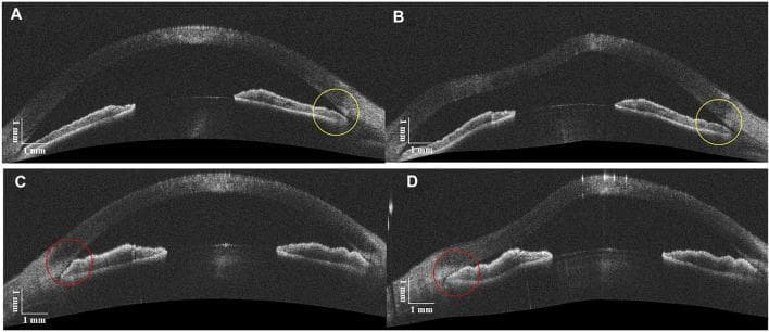 This diagnostic image displays four cross-sectional B-scans of the anterior segment of the human eye obtained via Deformable Anterior Segment Optical Coherence Tomography (DAS-OCT). The images demonstrate the dynamic response of the anterior chamber angle (ACA) to an air-puff stimulus, functioning as a non-contact form of indentation gonioscopy to differentiate between appositional and synechial angle closure.
Panels A and B (Top) show an eye with No Peripheral Anterior Synechiae (NPAS). In panel A (baseline), the angle appears narrow. In panel B, after the air puff, the yellow circles highlight a widening of the ACA, indicating that the iris-cornea contact was purely appositional and reversible.
Panels C and D (Bottom) show an eye with Peripheral Anterior Synechiae (PAS). In panel C (baseline), the angle is closed. In panel D, following the air puff, red circles indicate that the angle remains closed despite the increased pressure, confirming permanent adhesions (synechiae). These findings are critical for diagnosing and managing primary angle-closure glaucoma (PACG) by identifying permanent anatomical changes versus reversible apposition.