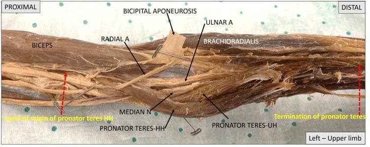 This cadaveric photograph illustrates the gross anatomy of the left cubital fossa and proximal forearm, oriented from proximal (left) to distal (right). Key muscular landmarks include the biceps brachii, brachioradialis, and the two heads of the pronator teres (humeral head - HH and ulnar head - UH). The bicipital aponeurosis is reflected to reveal underlying neurovascular structures. The median nerve (MEDIAN N) is clearly visible traversing the cubital fossa, passing between the humeral and ulnar heads of the pronator teres muscle. Proximally, the brachial artery bifurcation is demonstrated, showing the radial artery (RADIAL A) coursing superficially toward the lateral forearm and the ulnar artery (ULNAR A) diving deeper, posterior to the pronator teres. Red dotted arrows indicate the functional extent of the pronator teres muscle from its origin at the medial epicondyle to its termination on the radius. This image serves as an educational tool for identifying the spatial relationships and potential entrapment sites of the median nerve in the proximal forearm.