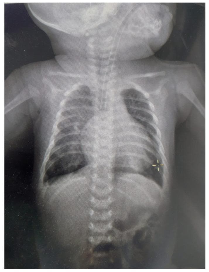 Anteroposterior (AP) chest radiograph of a one-month-old infant in a neonatal intensive care setting. The image demonstrates a significantly enlarged cardiac silhouette with a cardiothoracic ratio exceeding 0.6, suggestive of cardiomegaly. There is a visible endotracheal tube in situ, confirming mechanical ventilation. The lung fields show generalized increased opacity and decreased lung volumes consistent with pulmonary hypoventilation. Accentuation of the pulmonary hilar regions is noted, indicating increased pulmonary vascular markings and potential pulmonary congestion or overload. Bony structures, including the ribs, clavicles, and vertebral column, appear appropriate for age without gross fractures. The overall clinical picture is indicative of congenital heart disease, specifically a complete atrioventricular canal defect (CAVC), leading to cardiac enlargement and pulmonary circulatory overload.