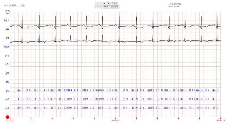 A diagnostic image showing a multi-lead electrocardiogram (ECG) waveform display on a standard red grid background. The image presents two continuous traces labeled as 'MLII' (Modified Limb Lead II) and 'V5', which are common leads used for arrhythmia monitoring. The waveforms demonstrate regular R-R intervals and narrow QRS complexes, with visible P waves and T waves associated with each heartbeat. Below the waveforms, structured text annotations (including labels 'pu', 'pu0', and 'pu1') provide algorithmic beat-by-beat analysis and fiducial point markings, such as identified P and T wave peaks. Time stamps are visible along the x-axis, ranging from 00:00:00 to 00:00:10, indicating a 10-second recording segment. This visual material is used in medical education to demonstrate normal sinus rhythm versus rhythm disturbances (arrhythmias) and to illustrate digital ECG signal processing and annotation techniques found in clinical database software like PhysioNet.