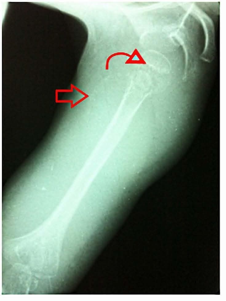 Anteroposterior diagnostic X-ray radiography of a pediatric right humerus and shoulder region, demonstrating classic skeletal manifestations of infantile scurvy (hypovitaminosis C). The image features a prominent, dense transverse radiopaque line at the distal metaphysis, known as the 'white line of Frankel' (indicated by a curved red arrow), representing a zone of provisional calcification. Along the humeral diaphysis, there is visible periosteal elevation or separation from the underlying cortex (marked by a straight red arrow), consistent with subperiosteal hemorrhage. The epiphyses appear osteopenic with a thin sclerotic rim, characteristic of Wimberger's ring sign. These findings illustrate the impact of impaired collagen synthesis on osteoblast function and capillary integrity. The educational focus is on identifying radiographic signs of nutritional deficiencies in pediatric orthopedics and radiology.