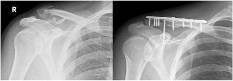 Two anteroposterior (AP) radiographs of the right shoulder demonstrate a comparison between a pre-operative and post-operative state of a lateral clavicle fracture. The pre-operative image (left) shows a displaced, fragmented fracture of the distal (lateral) third of the clavicle, consistent with a Neer Type IIB classification, which indicates coracoclavicular ligament involvement and inherent instability. The post-operative image (right) displays the results of open reduction and internal fixation (ORIF). Visible hardware includes a locking compression plate (LCP) positioned on the superior aspect of the clavicle, secured by multiple cortical and locking screws. A long coracoclavicular (CC) screw is notably inserted through the plate, traversing from the clavicle into the coracoid process of the scapula to provide additional stability and address ligamentous disruption. The radiographs highlight key orthopedic concepts in shoulder trauma management, specifically the stabilization of unstable distal clavicle fractures to prevent non-union and restore joint mechanics.