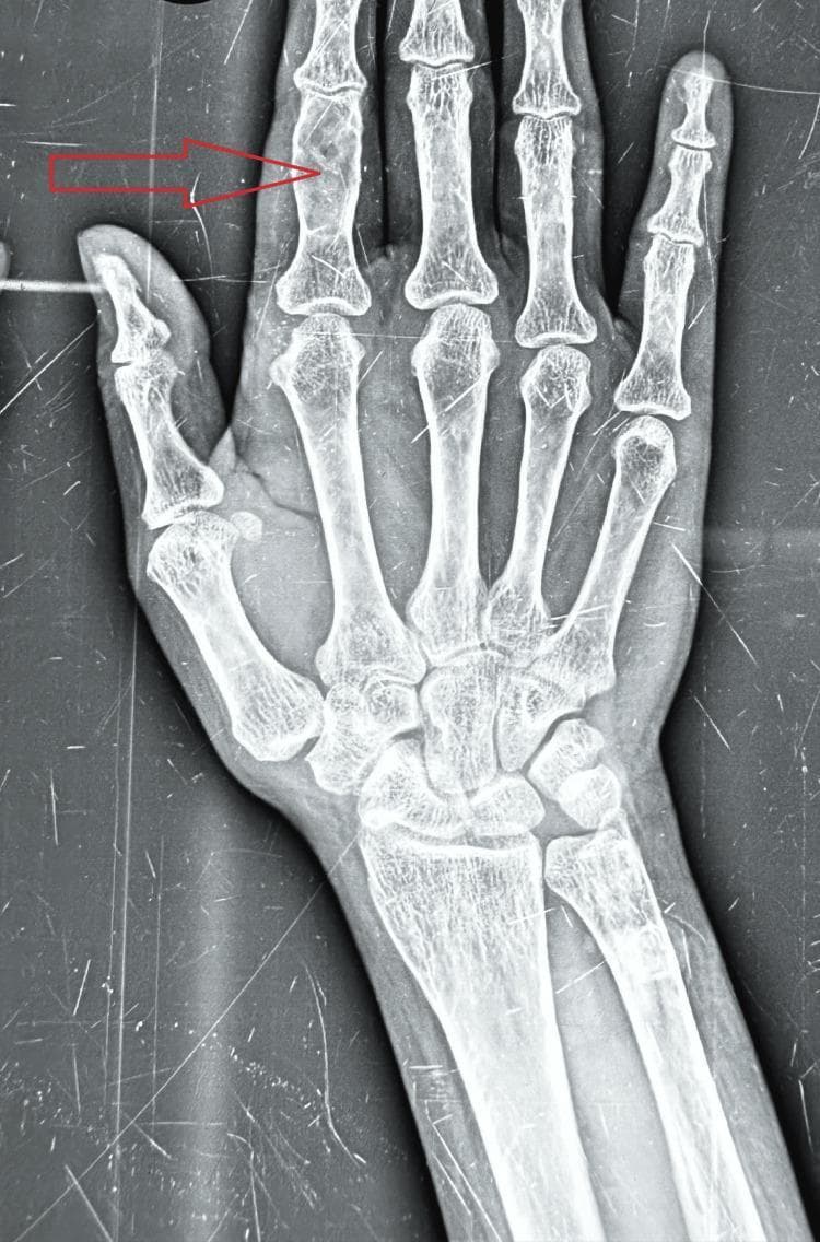 This diagnostic X-ray (radiography) of the right hand in a posterior-anterior view illustrates classic skeletal manifestations of primary hyperparathyroidism. The image focuses on the second digit (index finger), specifically the middle and proximal phalanges. Key findings include prominent subperiosteal bone resorption along the radial aspect of the middle phalanx, characterized by a 'lace-like' cortical irregularity and thinning. Additionally, a localized lytic lesion with well-defined borders and decreased radiodensity is visible within the medullary cavity, consistent with a bone cyst or brown tumor. These features are hallmark signs of high bone turnover states associated with excess parathyroid hormone (PTH). The rest of the hand bones show a generalized decrease in bone density. This image is of high educational value for medical students and endocrinology residents in identifying pathognomonic radiological signs of renal osteodystrophy or hyperparathyroidism.