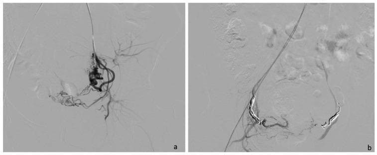 This diagnostic image pair displays Digital Subtraction Angiography (DSA) of the pelvic region, specifically focused on a uterine artery embolization (UAE) procedure. Panel (a) illustrates a pre-embolization selective angiogram of the uterine artery. It shows a dense, complex network of hypervascular branching structures and tortuous vessels consistent with the increased blood supply required for a gestational sac in a cesarean scar pregnancy (CSP). Contrast medium clearly delineates the arterial anatomy and distal capillary blush. Panel (b) shows the final post-procedural control angiography. The previous vascular network is no longer opacified, indicating a successful cessation of blood flow. Highly radiopaque, coiled metallic embolization agents (Interlock or Nester coils) are visible within the arterial lumens, serving as the mechanical obstruction. This comparison demonstrates the therapeutic devascularization of the affected uterine segment to prevent hemorrhage during subsequent surgical evacuation. The image is a critical educational tool for interventional radiology and obstetrics, highlighting the role of minimally invasive techniques in managing complex ectopic pregnancies.